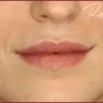 Dermal Fillers Before & After Patient #1186