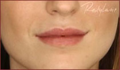 Dermal Fillers Before & After Patient #1186