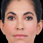 Dermal Fillers Before & After Patient #1187