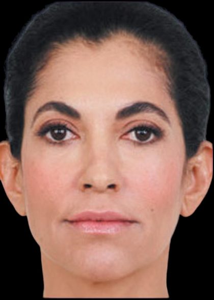 Dermal Fillers Before & After Patient #1187