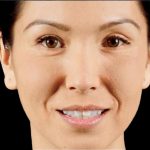 Dermal Fillers Before & After Patient #1188