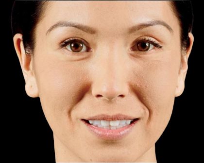 Dermal Fillers Before & After Patient #1188