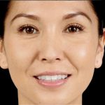 Dermal Fillers Before & After Patient #1188