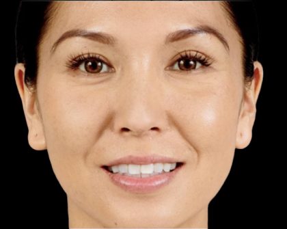 Dermal Fillers Before & After Patient #1188