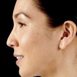 Dermal Fillers Before & After Patient #1188