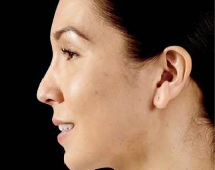 Dermal Fillers Before & After Patient #1188