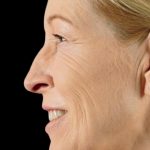 Dermal Fillers Before & After Patient #1190