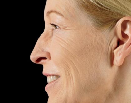 Dermal Fillers Before & After Patient #1190