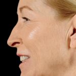 Dermal Fillers Before & After Patient #1190
