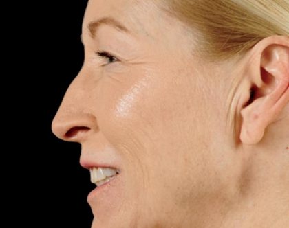 Dermal Fillers Before & After Patient #1190