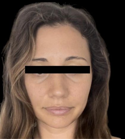 Dermal Fillers Before & After Patient #1191
