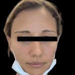 Dermal Fillers Before & After Patient #1191