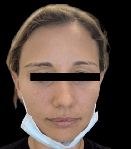 Dermal Fillers Before & After Patient #1191
