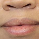 Dermal Fillers Before & After Patient #1193