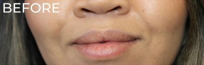 Dermal Fillers Before & After Patient #1193