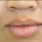 Dermal Fillers Before & After Patient #1193