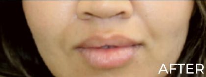 Dermal Fillers Before & After Patient #1193