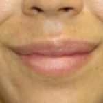 Dermal Fillers Before & After Patient #1194