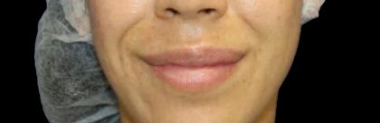 Dermal Fillers Before & After Patient #1194