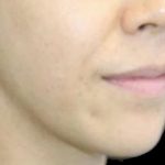 Dermal Fillers Before & After Patient #1194