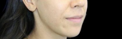 Dermal Fillers Before & After Patient #1194