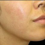 Dermal Fillers Before & After Patient #1194