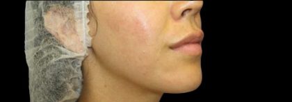 Dermal Fillers Before & After Patient #1194