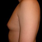 Gynecomastia Before & After Patient #631