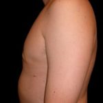 Gynecomastia Before & After Patient #631
