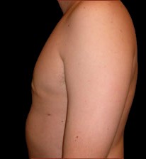 Gynecomastia Before & After Patient #631