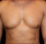 Gynecomastia Before & After Patient #632