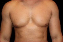 Gynecomastia Before & After Patient #632