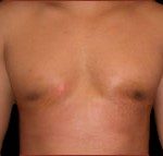 Gynecomastia Before & After Patient #632