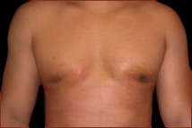 Gynecomastia Before & After Patient #632