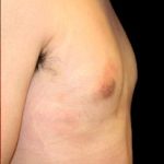 Gynecomastia Before & After Patient #639