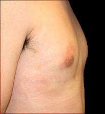 Gynecomastia Before & After Patient #639