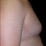 Gynecomastia Before & After Patient #641