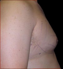 Gynecomastia Before & After Patient #641
