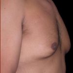 Gynecomastia Before & After Patient #642