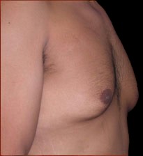 Gynecomastia Before & After Patient #642