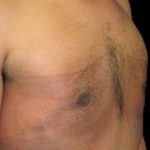 Gynecomastia Before & After Patient #642