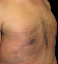 Gynecomastia Before & After Patient #642