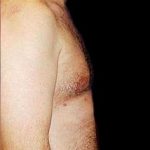 Gynecomastia Before & After Patient #643