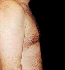 Gynecomastia Before & After Patient #643