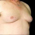 Gynecomastia Before & After Patient #646