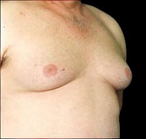 Gynecomastia Before & After Patient #646
