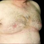 Gynecomastia Before & After Patient #646