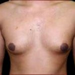 Gynecomastia Before & After Patient #647