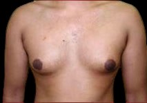 Gynecomastia Before & After Patient #647