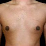 Gynecomastia Before & After Patient #647